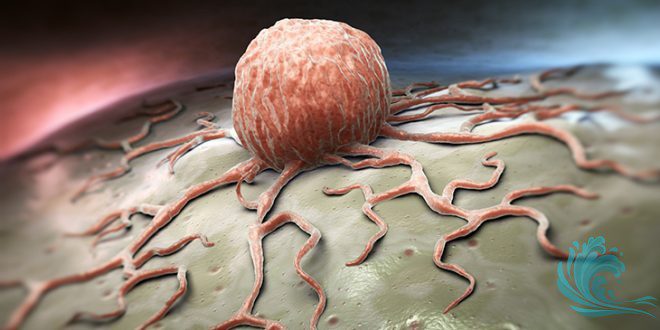 Kanserin Sebepleri, Nedenleri Nelerdir? – İstemi.net Kişisel Blog Sitesi